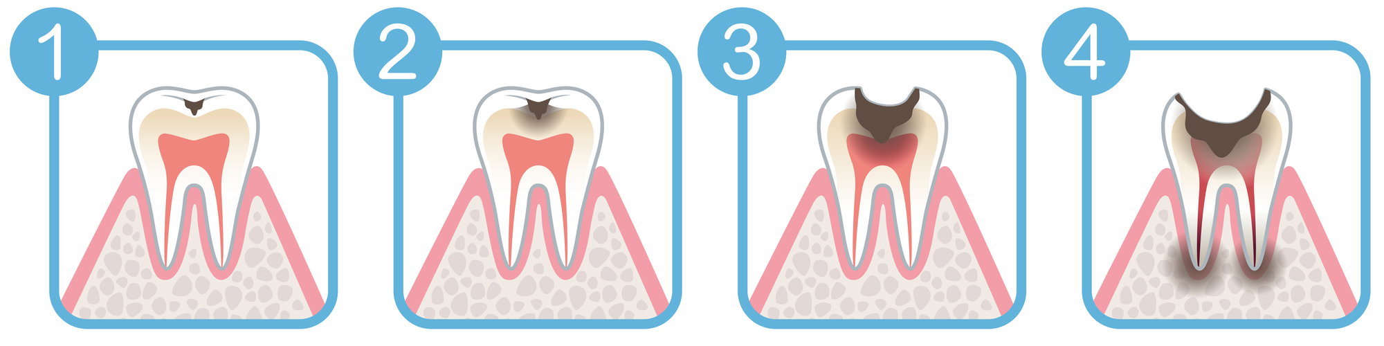 むし歯の進行