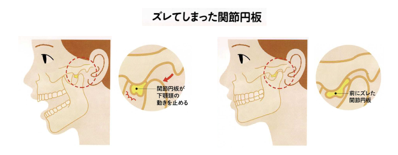 過剰な負担で関節円板がズレズレ！